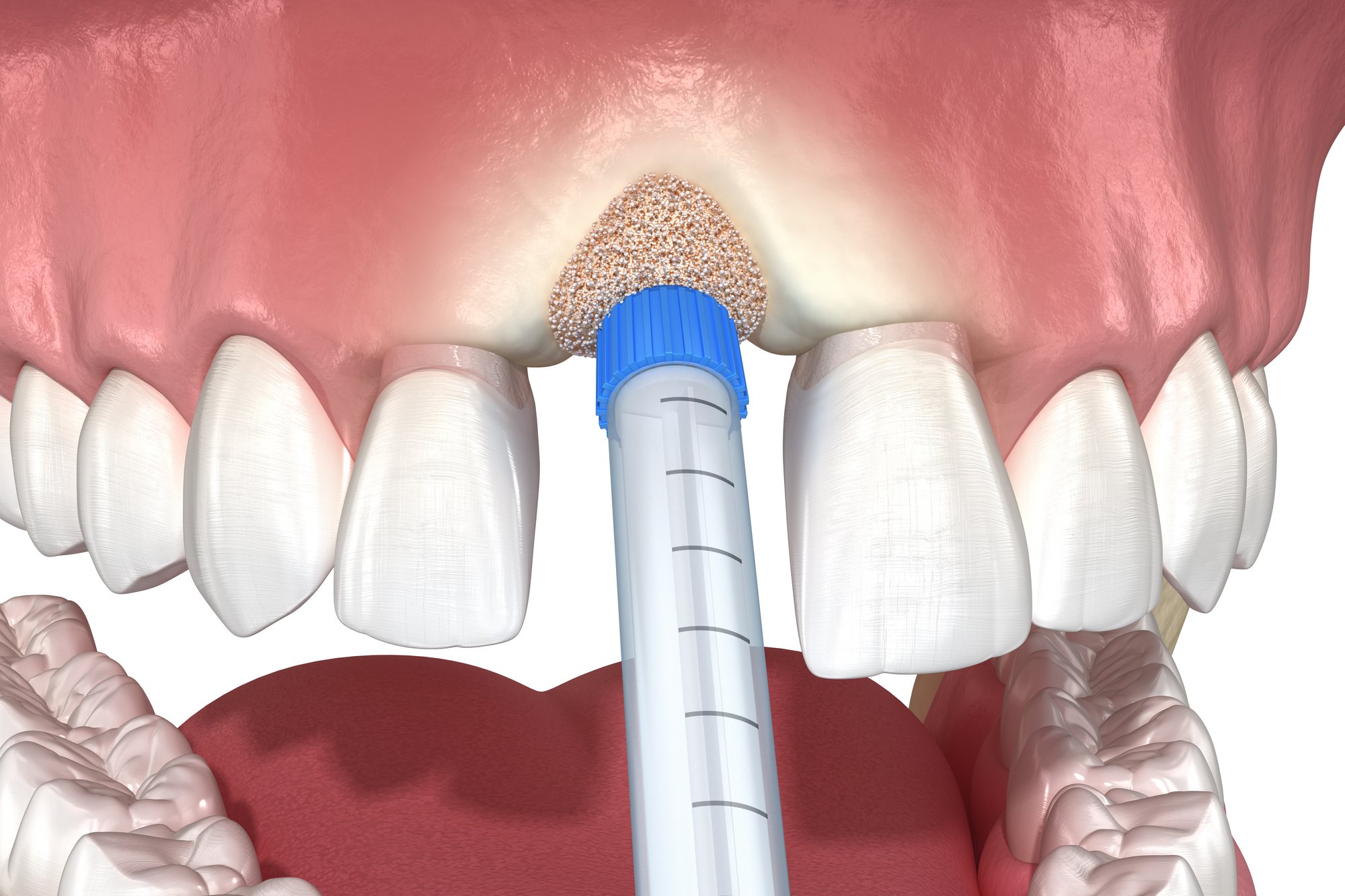 Do I Always Need a Bone Graft for an Implant?
